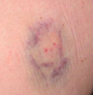 bruise2
