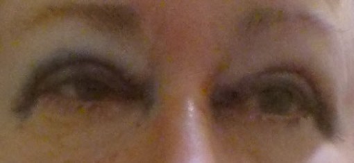 after_surgery_20150709_02